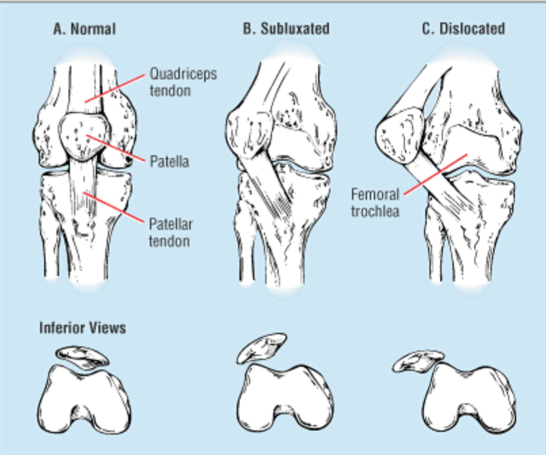 Patellar Instability My Kneecap Goes Out Ssor Physical Therapy